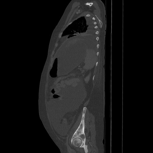 File:Breast cancer metastases - hepatic and skeletal (Radiopaedia 34201-35461 Sagittal bone window 72).jpg
