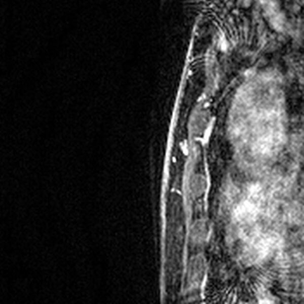 File:Breast implants - MRI (Radiopaedia 26864-27035 Sagittal T2 73).jpg
