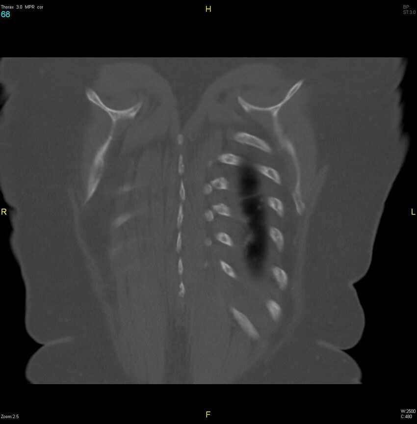 Breast primary with lung and bone metastases (Radiopaedia 40620-43228 bone window 68).jpg