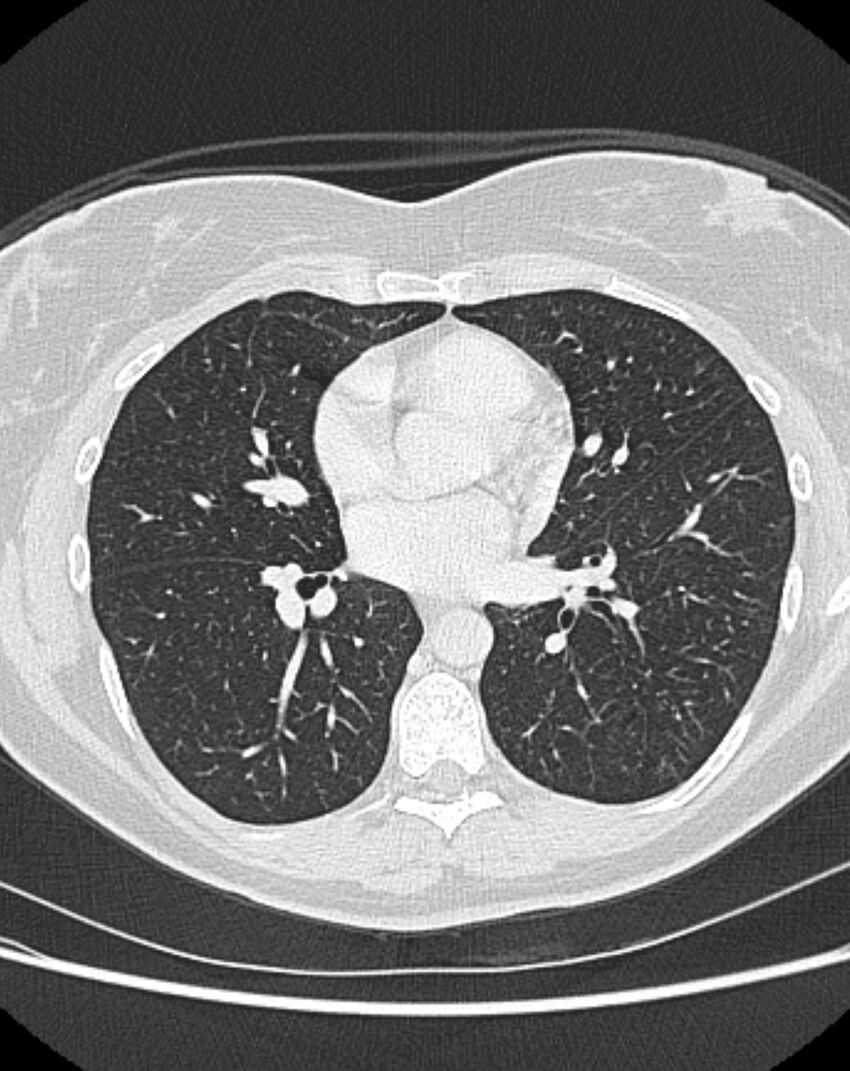Bronchial atresia (Radiopaedia 50007-55297 Axial lung window 59).jpg