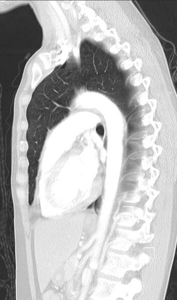 File:Bronchial atresia (Radiopaedia 73677-84470 Sagittal lung window 31).jpg
