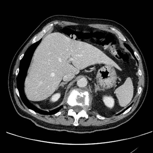 File:Bronchogenic carcinoma with L1 vertebra metastasis (Radiopaedia 9096-9805 Axial C+ delayed 33).jpg