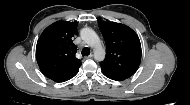 File:Bronchogenic carcinoma with superior vena cava syndrome (Radiopaedia 36497-38054 Axial C+ delayed 28).jpg