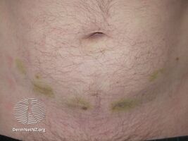 Bruising at the site of heparin injections