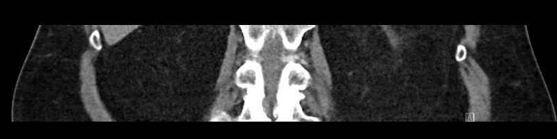 File:Buried bumper syndrome - gastrostomy tube (Radiopaedia 63843-72575 Coronal Inject 76).jpg