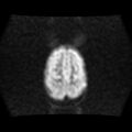 Burkitt lymphoma of the orbit- pre and post chemotherapy (Radiopaedia 31214-31929 Axial DWI 14).jpg