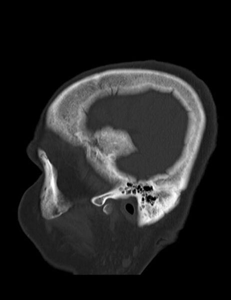 File:Burnt-out meningioma (Radiopaedia 51557-57337 Sagittal bone window 40).jpg