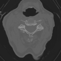 C2 fracture with vertebral artery dissection (Radiopaedia 37378-39199 Axial bone window 25).png