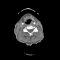 C2 fracture with vertebral artery dissection (Radiopaedia 37378-39200 A 125).png