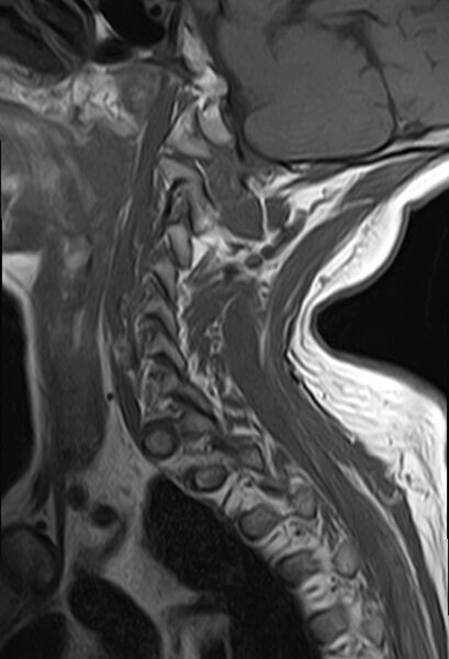 File:Calcified meningioma - cervical canal (Radiopaedia 70136-82468 Sagittal T1 4).jpg