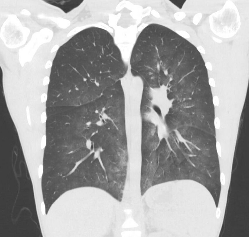 Cannabis-induced diffuse alveolar hemorrhage (Radiopaedia 89834-106946 Coronal lung window 36).jpg