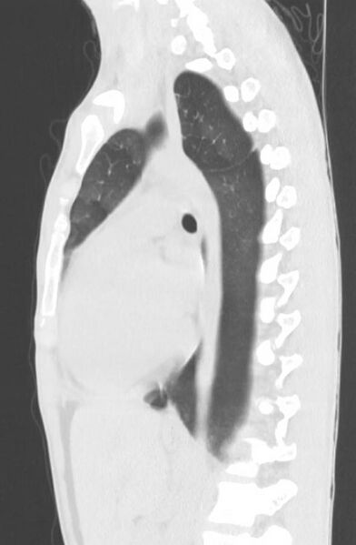 File:Cannabis-induced diffuse alveolar hemorrhage (Radiopaedia 89834-106946 Sagittal lung window 78).jpg