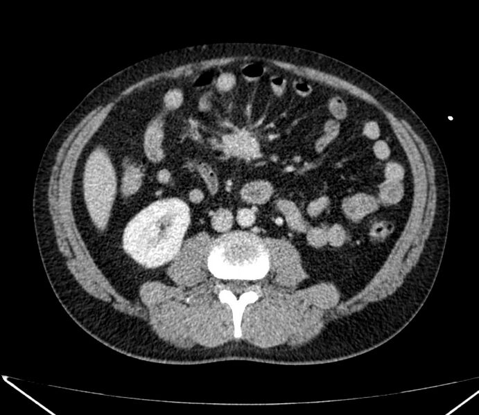 File:Carcinoid tumor with hepatic metastases (Radiopaedia 22651-22670 C 53).jpg