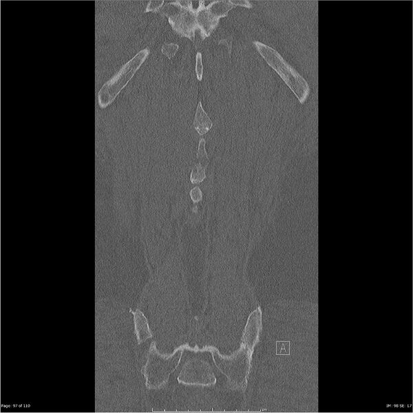 File:Cardiac trauma (Radiopaedia 32874-33858 Coronal bone window 97).jpg