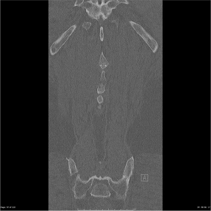 Cardiac trauma (Radiopaedia 32874-33858 Coronal bone window 97).jpg
