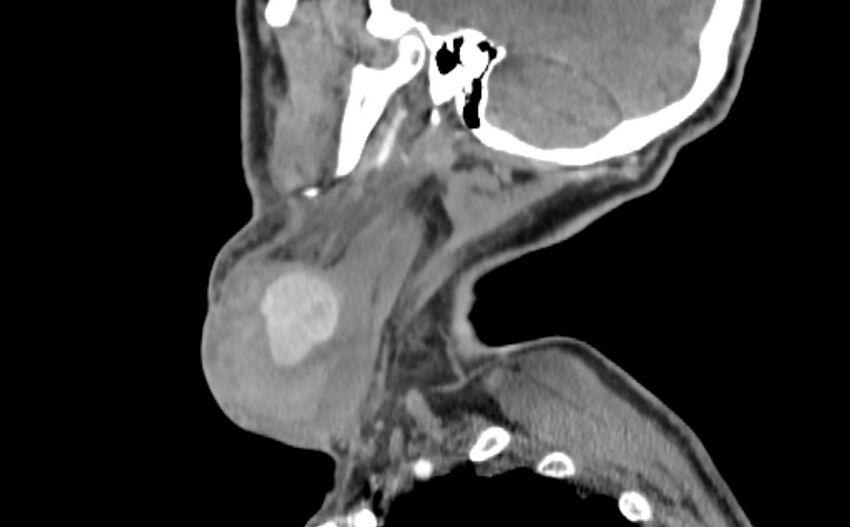 Carotid artery pseudoaneurysm (Radiopaedia 84030-99259 E 50).jpg