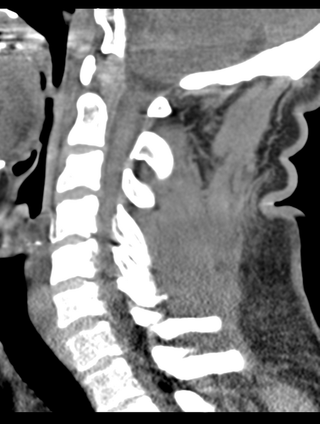 File:Cavernoma of cervical cord (Radiopaedia 50838-56346 B 44).png