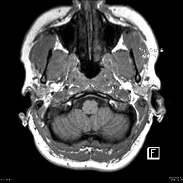 File:Cavernous malformation (cavernous angioma or cavernoma) (Radiopaedia 36675-38237 Axial T1 6).jpg