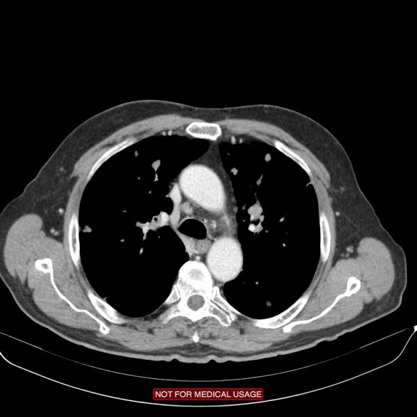 File:Cavitating pulmonary metastases (Radiopaedia 24920-25184 B 8).jpg