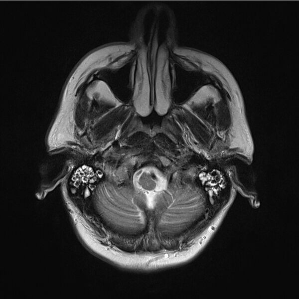 File:Central base of skull meningioma (Radiopaedia 53531-59549 Axial T2 3).jpg