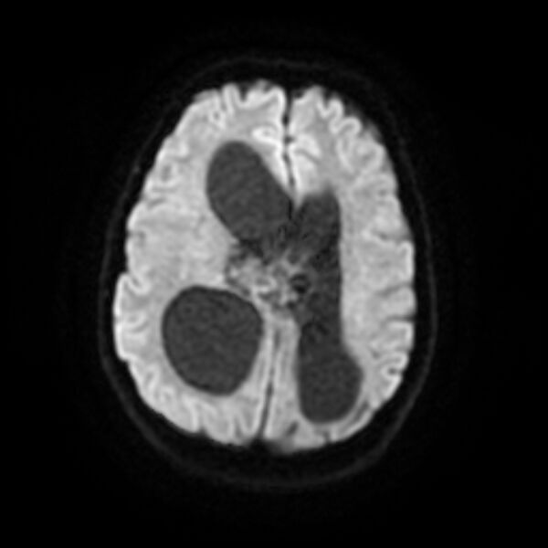 File:Central neurocytoma (Radiopaedia 67618-77021 Axial DWI 15).jpg