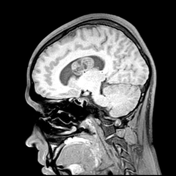 File:Central neurocytoma (Radiopaedia 79320-92380 Sagittal T1 110).jpg