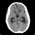 Cerebellar abscess secondary to mastoiditis (Radiopaedia 26284-26412 Axial non-contrast 64).jpg