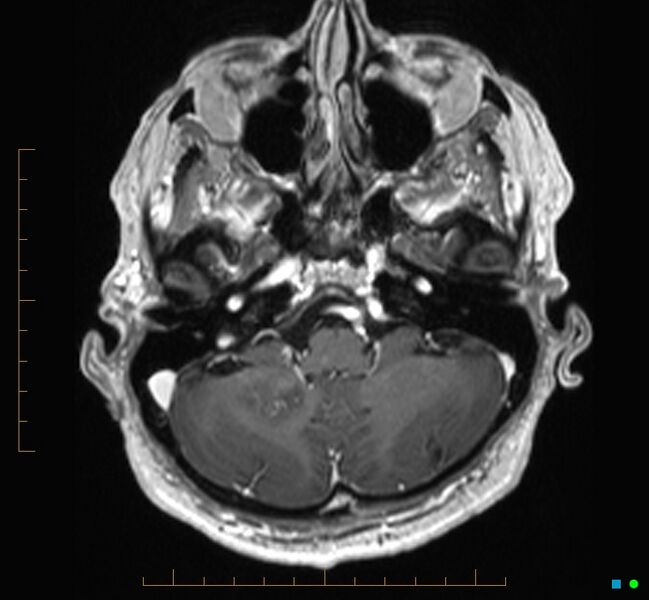 File:Cerebellar gangliocytoma (Radiopaedia 65377-74422 Axial T1 C+ 19).jpg