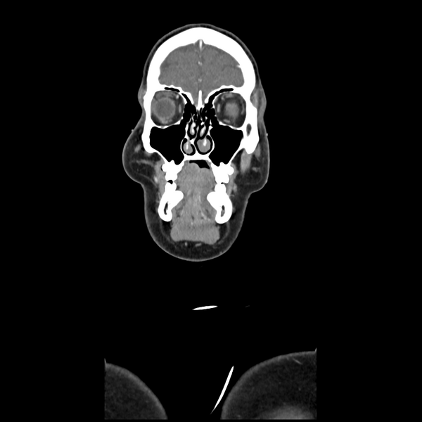 File:Cerebellar infarct due to vertebral artery dissection with posterior fossa decompression (Radiopaedia 82779-97029 D 11).png