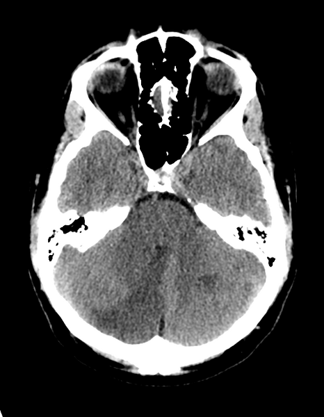 File:Cerebellar infarct due to vertebral artery dissection with posterior fossa decompression (Radiopaedia 82779-97030 Axial non-contrast 11).png