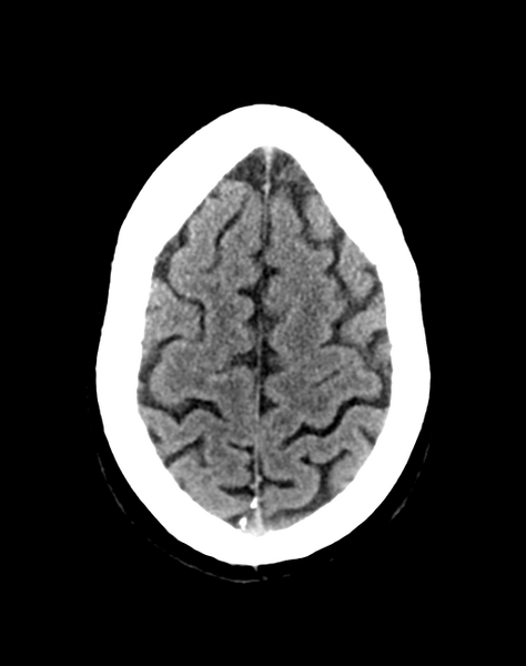 File:Cerebellar infarct due to vertebral artery dissection with posterior fossa decompression (Radiopaedia 82779-97033 Axial non-contrast 30).png