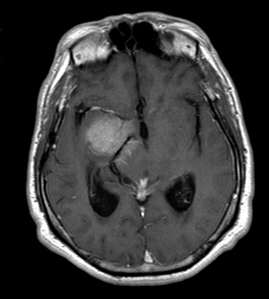 File:Cerebellopontine angle meningioma (Radiopaedia 24459-24764 Axial T1 C+ 12).jpg