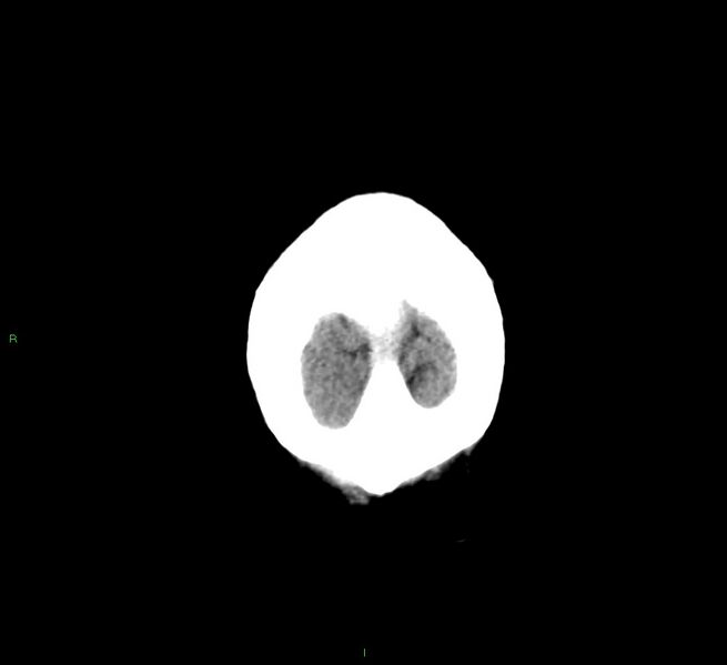 File:Cerebral amyloid angiopathy-associated lobar intracerebral hemorrhage (Radiopaedia 58376-65511 Coronal non-contrast 6).jpg