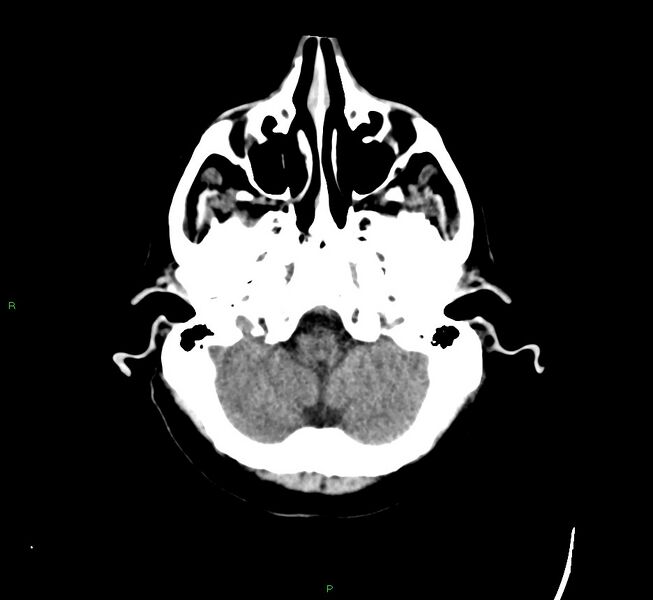File:Cerebral amyloid angiopathy-associated lobar intracerebral hemorrhage (Radiopaedia 58529-65681 Axial non-contrast 44).jpg