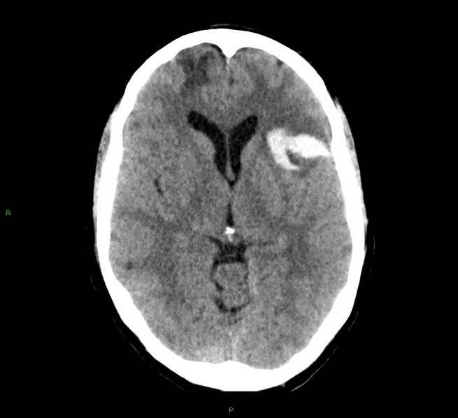 File:Cerebral amyloid angiopathy-associated lobar intracerebral hemorrhage (Radiopaedia 58529-65687 Axial non-contrast 29).jpg