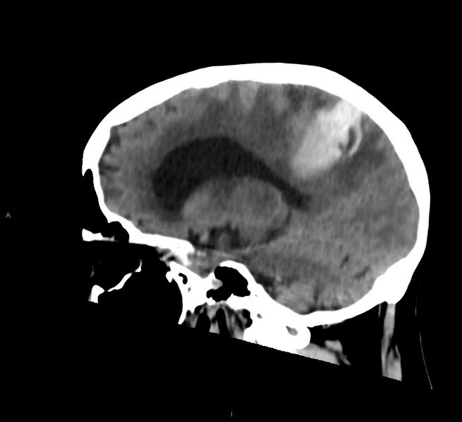 File:Cerebral amyloid angiopathy-associated lobar intracerebral hemorrhage (Radiopaedia 58530-65688 C 33).jpg