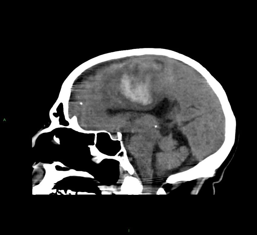 Cerebral amyloid angiopathy-associated lobar intracerebral hemorrhage (Radiopaedia 58560-65723 C 26).jpg
