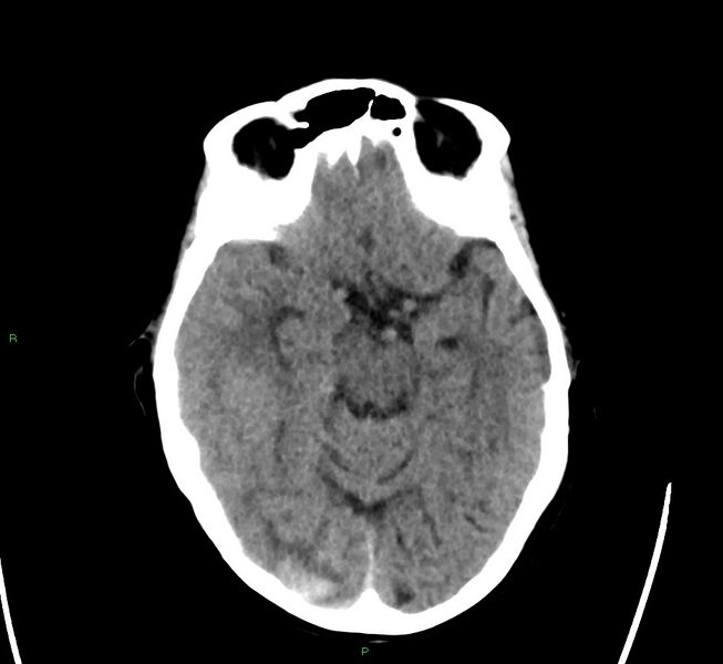 File:Cerebral amyloid angiopathy-associated lobar intracerebral hemorrhage (Radiopaedia 58563-65727 Axial non-contrast 35).jpg