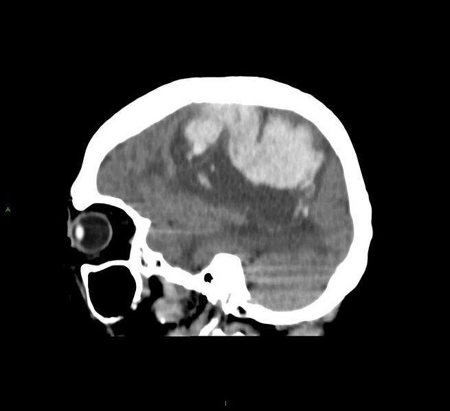 File:Cerebral amyloid angiopathy-associated lobar intracerebral hemorrhage (Radiopaedia 58751-65972 C 18).jpg
