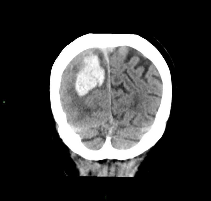 Cerebral amyloid angiopathy-associated lobar intracerebral hemorrhage (Radiopaedia 59356-66716 Coronal non-contrast 14).jpg