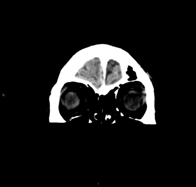 File:Cerebral amyloid angiopathy-associated lobar intracerebral hemorrhage (Radiopaedia 59356-66716 Coronal non-contrast 57).jpg
