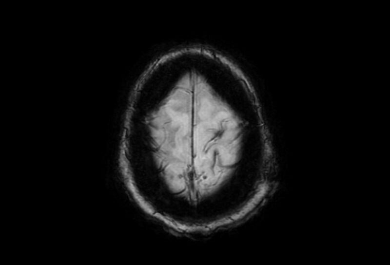 File:Cerebral amyloid angiopathy (Radiopaedia 86671-102792 Axial Gradient Echo 4).jpg