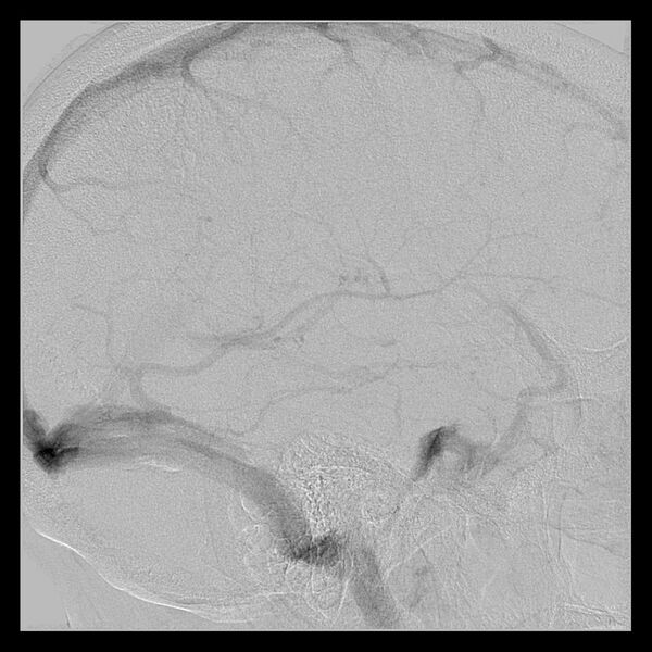File:Cerebral aneurysm with rupture (Radiopaedia 29933-30458 LT CCA IC 49).jpg