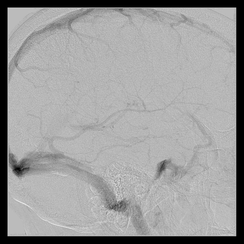 Cerebral aneurysm with rupture (Radiopaedia 29933-30458 LT CCA IC 49).jpg