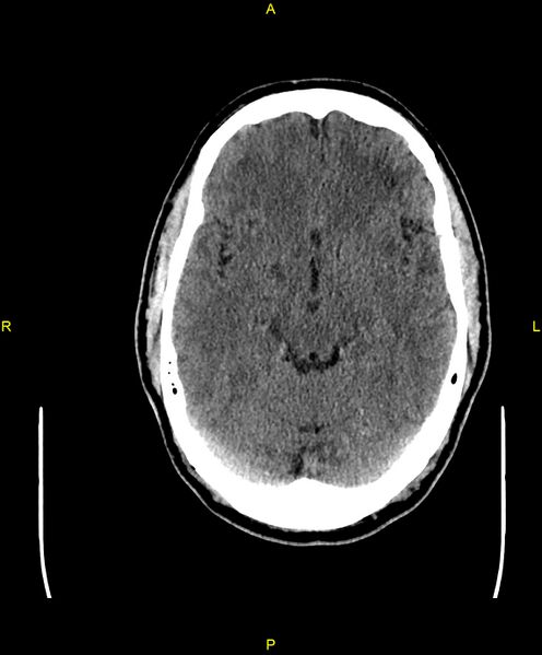 File:Cerebral autosomal dominant arteriopathy with subcortical infarcts and leukoencephalopathy (CADASIL) (Radiopaedia 86108-102051 Axial non-contrast 42).jpg