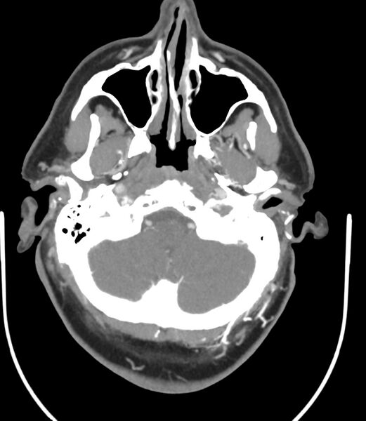 File:Cerebral dural venous sinus thrombosis (Radiopaedia 86514-102576 A 28).jpg