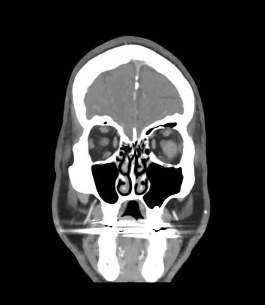 File:Cerebral dural venous sinus thrombosis (Radiopaedia 86514-102576 B 5).jpg