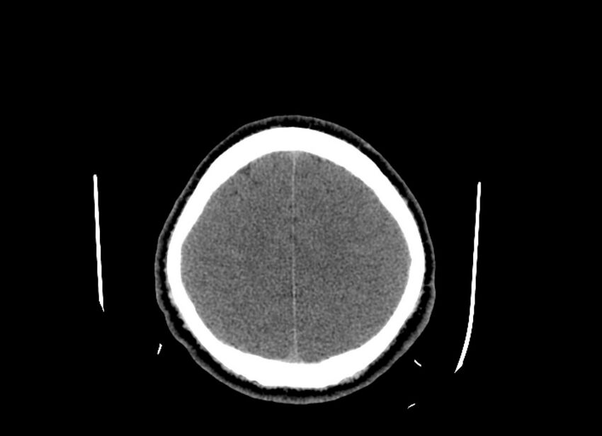 Cerebral edema (Radiopaedia 82519-96661 Axial non-contrast 13).jpg