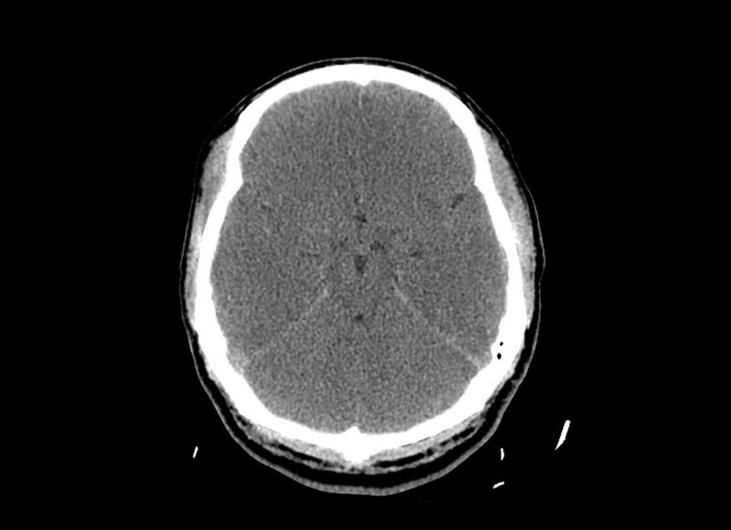 File:Cerebral edema (Radiopaedia 82519-96661 Axial non-contrast 35).jpg