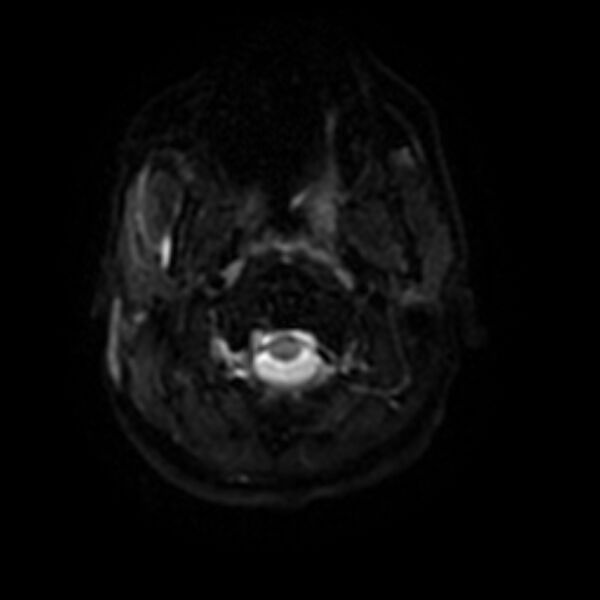 File:Cerebral fat embolism (Radiopaedia 37510-39363 Axial DWI 25).jpg